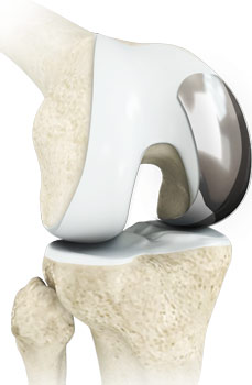 Bone Conserving Partial Knee Replacement
